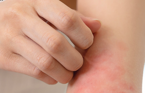 Le reazioni avverse cutanee da farmaci: come riconoscerle e come trattarle